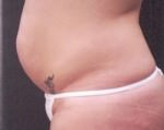 Tummy Tuck