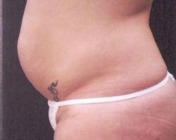 Tummy Tuck