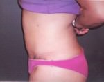 Tummy Tuck