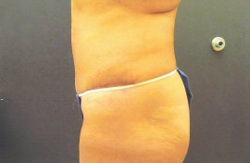 Tummy Tuck