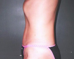 Tummy Tuck