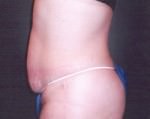 Tummy Tuck