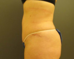 Tummy Tuck