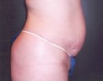 Tummy Tuck