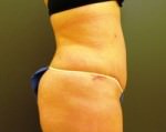 Tummy Tuck