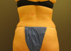 Tummy Tuck