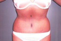 Tummy Tuck