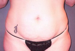 Tummy Tuck