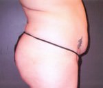 Tummy Tuck