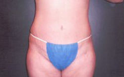 Tummy Tuck