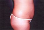 Tummy Tuck