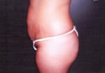 Tummy Tuck