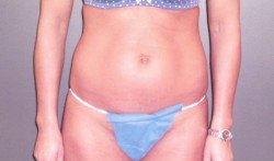 Tummy Tuck