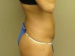 Tummy Tuck