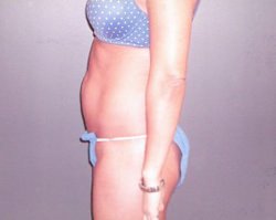 Tummy Tuck