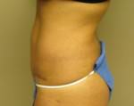 Tummy Tuck