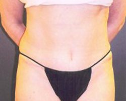 Tummy Tuck