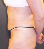 Tummy Tuck