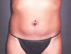 Tummy Tuck