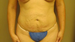 Tummy Tuck