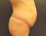 Tummy Tuck