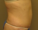 Tummy Tuck