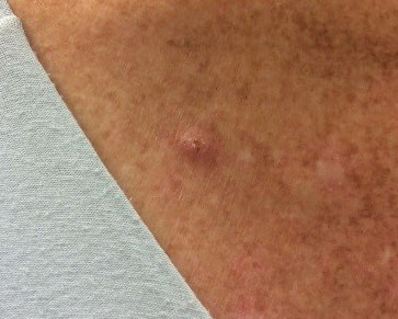 Squamous Cell Carcinoma