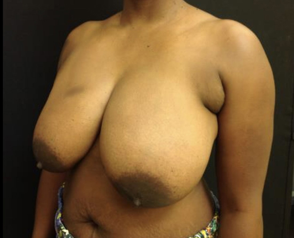 Breast Reduction