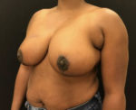 Breast Reduction