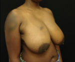 Breast Reduction