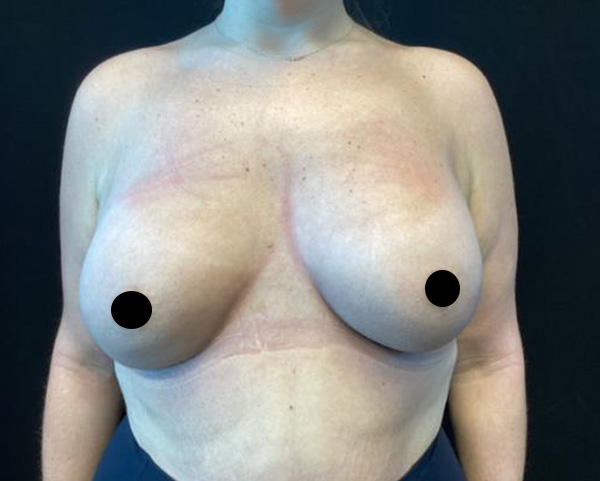 Breast Augmentation