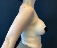 Breast Implant Removal