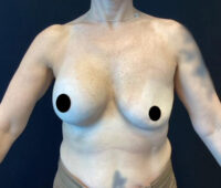 Breast Implant Removal