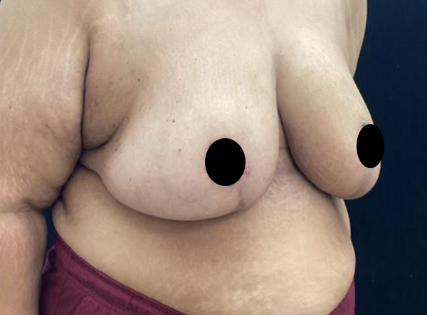 Breast Reduction